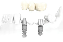 Affordable Dental Implant Solutions