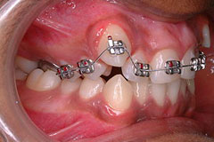 Quality Teeth Straightening Braces