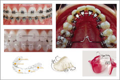 Braces Types