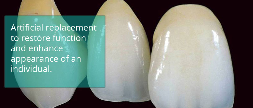 Dental Crowns, Bridges & Caps Implant