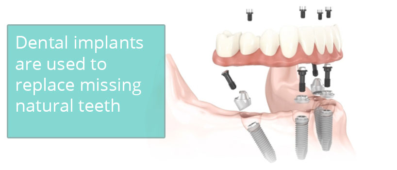 Dental Implant Surgery in Aurangabad