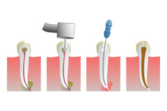 Affordable Root Canal Therapy & Surgery
