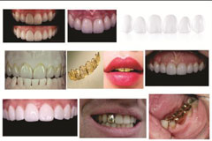 Smile Design Options