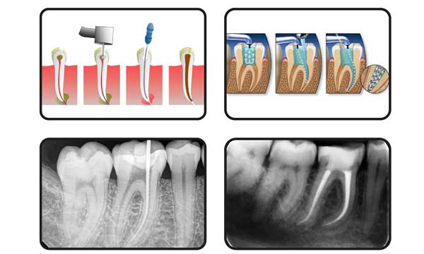 Advanced Root Canal