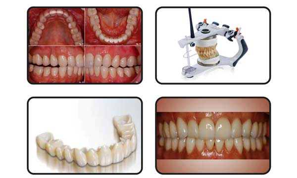 Full Mouth Rehabilitation