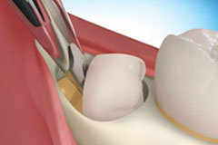 Affordable Wisdom Tooth Extraction Surgery